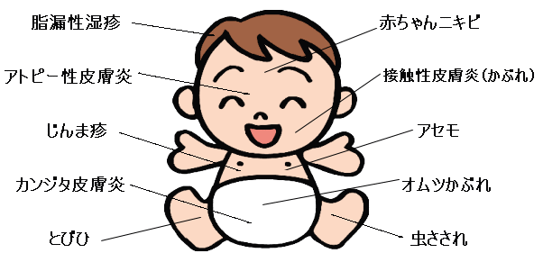 乳児のアトピー性皮膚炎